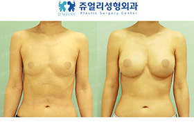 Breast Augmentation