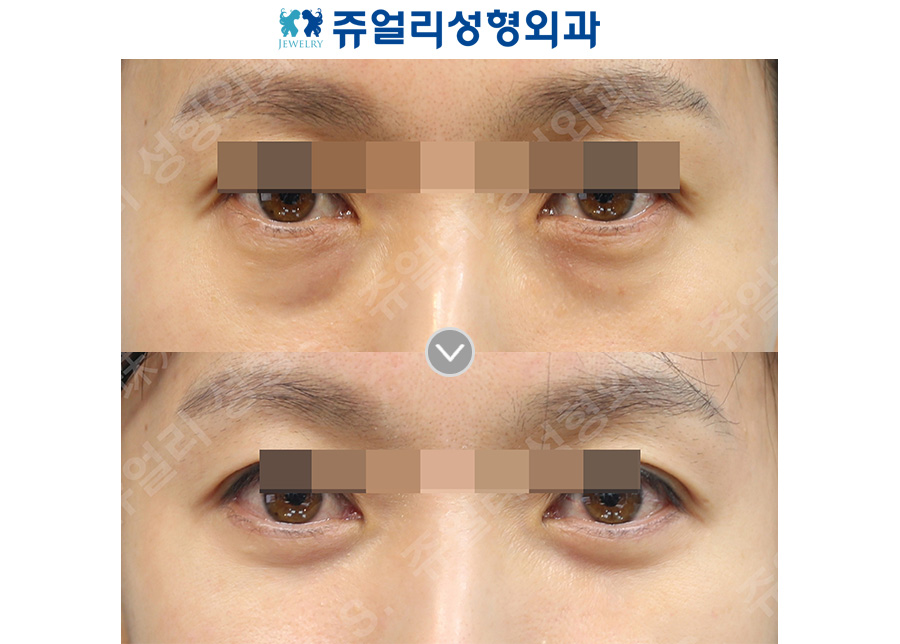 Lower blepharoplasty + midface lift