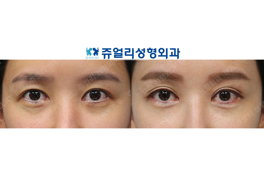 Double Eyelid Revision, Dark Circle Removal (Fat Repositioning)