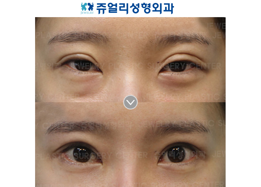 Incision Reoperation + Ptosis