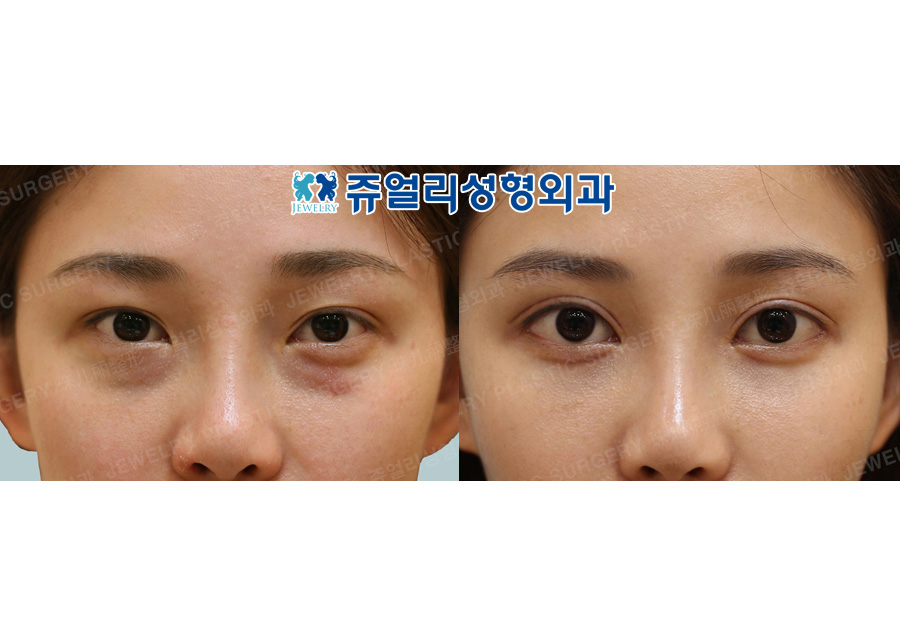 Double Eyelids Reoperation, Epi+Lateral+Lower Lateral Canthoplasty, Fat-Repositioning Transconjunctival + Loveband