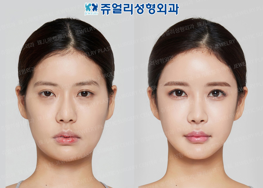 Cheekbone+Square Jaws Reduction+T-osteotomy, Double Eyelids Reoperation (Size Reduction+Eyes Enlargement)+Epi+Lateral Canthoplasty, Dark Circle Removal, Nose Reoperation (Deviated Nasal Septum, Costal Cartilage, Temporal Muscle Grafting), Fat Grafting