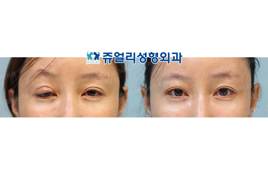 Eyes Reoperation (Ptosis side-effect occured)