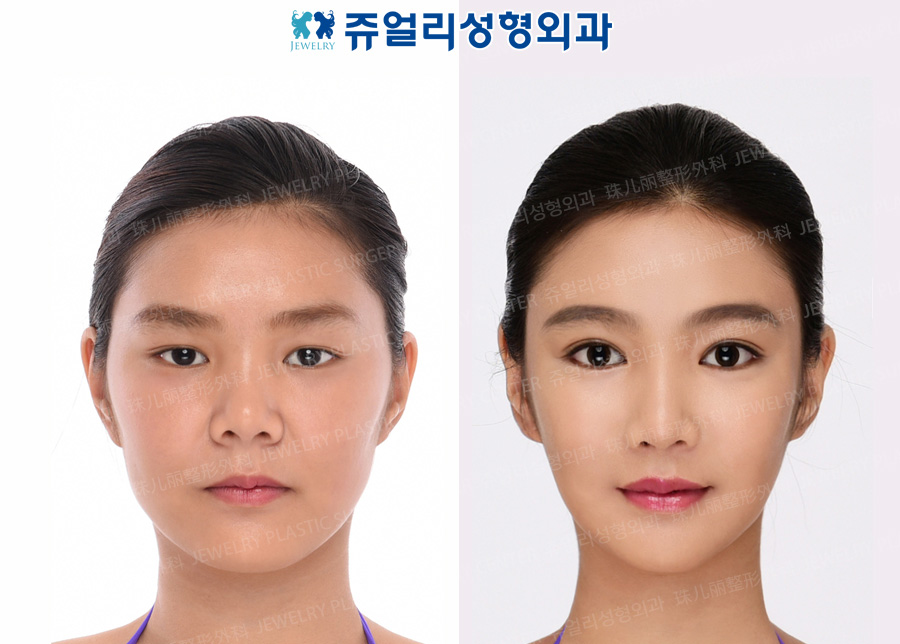 Ptosis, Lateral Canthoplasty, Lower Lateral Canthoplasty, Nose (Autogenous Costal Cartilage), Fat Grafting, Cheekbone Reduction+Square Jaws Reduction+T-osteotomy