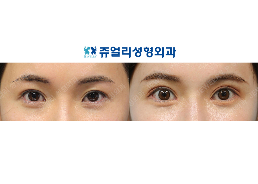 Double Eyelid Revision (Ptosis Correction) + Epicanthoplasty + Lateral Canthoplasty