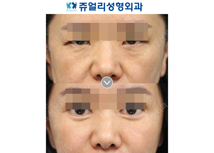 Lower blepharoplasty + midface lift