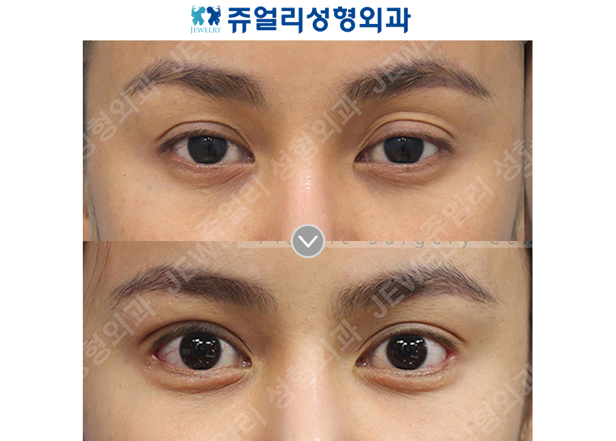 Double Eyelids Revision (Ptosis Correction), Lateral Canthoplasty, Lower Lateral Canthoplasty, Under Eye Fat Repositioning (Dark Circle Eye Bag Removal, Loveband)