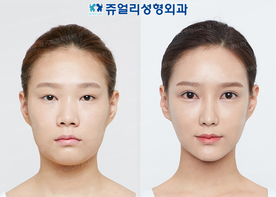 Double Eyelids (Incision) + All Back Canthoplasty (Lateral+Lower Lateral), Nose Surgery, Nostrils Reduction, Cube Fat Grafting, Chin Reduction, Cheekbone Reduction, Double Chin Liposuction
