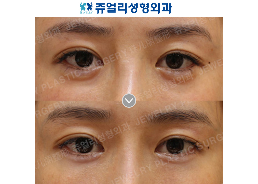 Dark Circles (Loveband Filler Removal) + Natural Loveband Surgery