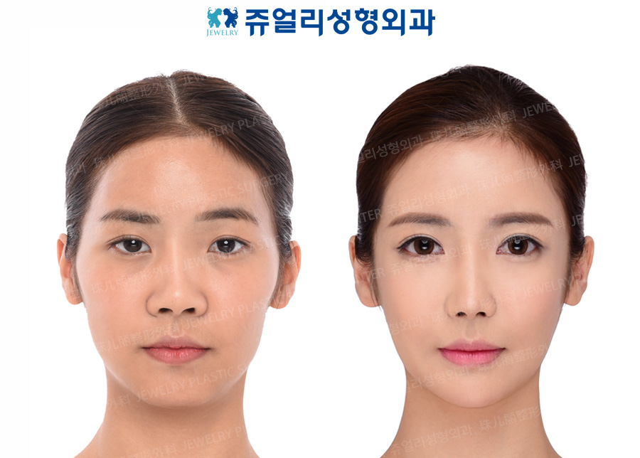 Ptosis, Epicanthoplasty, Lateral Canthoplasty, Dark Circle Removal, Nose Reoperation, Fat Grafting, Cheek/Chin Liposuction, Cheekbone Reduction