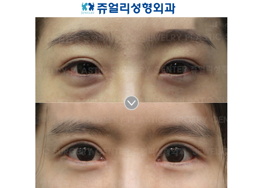 Incision Reoperation + Ptosis