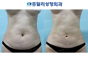 Abdominal Wall Surgery + Liposuction