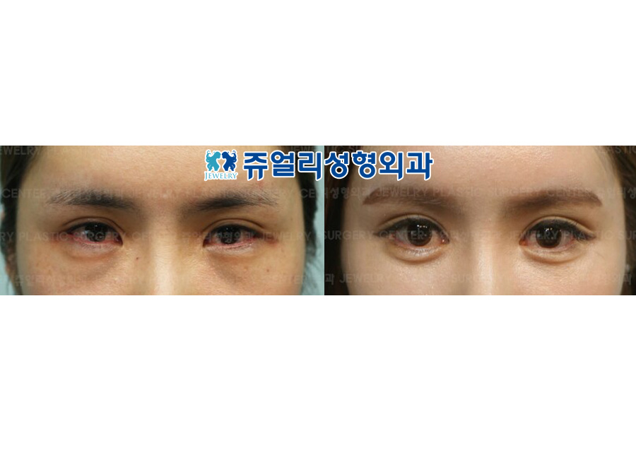 Ptosis + Epicanthoplasty + Lateral Canthoplasty + Lower Lateral Canthoplasty + Dark Circles + Loveband