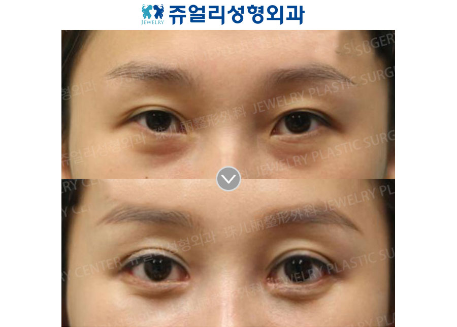 Double Eyelids Incision (Out-Line)