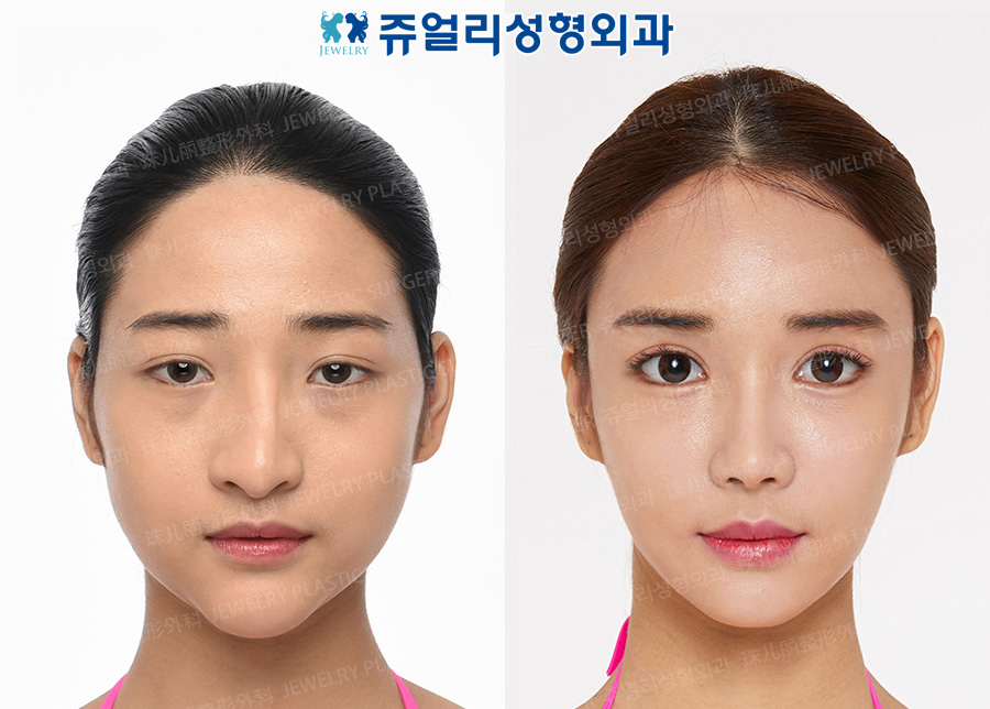 Eyes Surgery (Epicanthoplasty, Lateral Canthoplasty, Lower Lateral Canthoplasty, Fat-Repositioning Transconjunctival Blepharoplasty, Loveband), Nose Reoperation, Fat Grafting, Cheek/Chin Liposuction, Chin Implant, Chin Botox