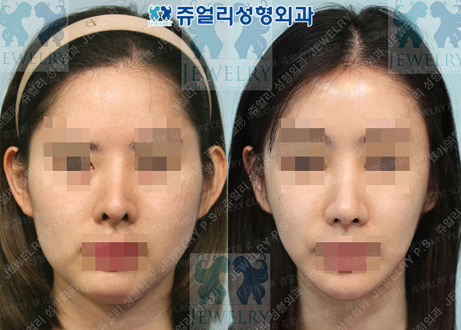 Rhinoplasty (autologous rib cartilage) + contouring (zygoma, square jaw, front chin reduction), fat grafting, cheek + double chin liposuction