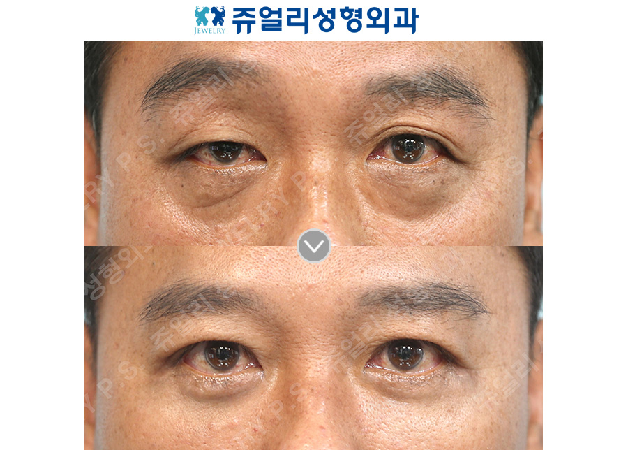 Upper blepharoplasty (ptosis correction) + lower blepharoplasty