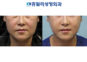 Mini Lifting (Jaw Line Lifting)