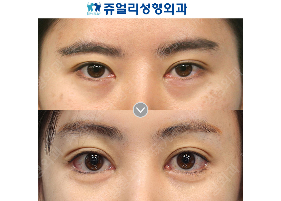 Double eyelid surgery (ptosis correction) + lateral, lower canthoplasty + under-eye fat repositioning + aegyo-sal