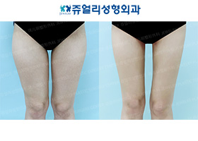 Thigh Liposuction