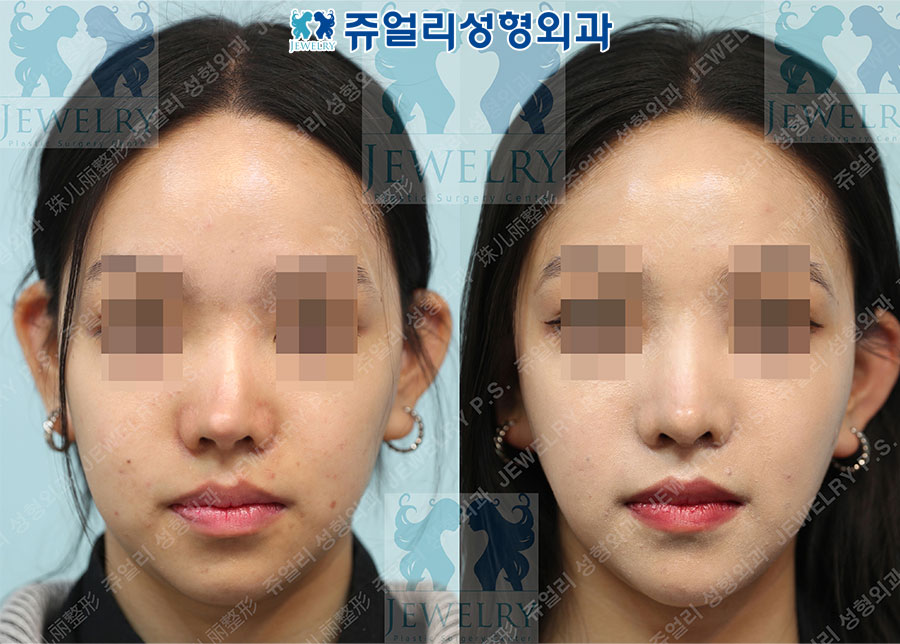 Revision rhinoplasty (3rd), contracted nose correction + autologous rib cartilage