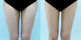 Thigh Liposuction