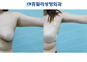 Arm Liposuction