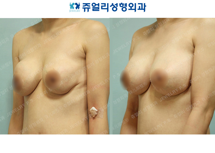 Breast Reoperation (Capsular Contracture, Areola Incision)