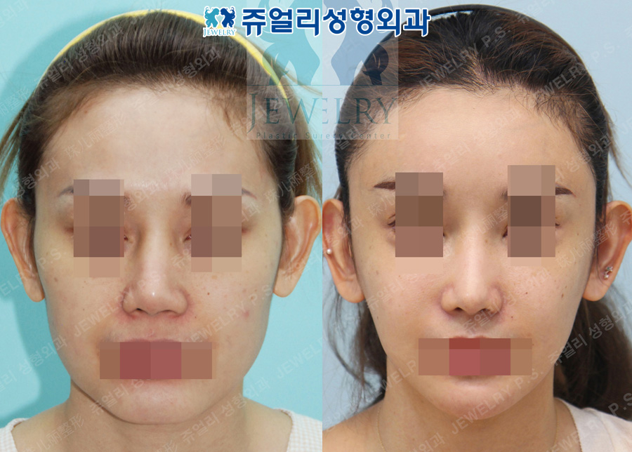 Rhinoplasty Revision (Using Rib Cartilage), Fat Grafting, Cheekbone Reduction, Square Jaw Reduction, T-osteotomy