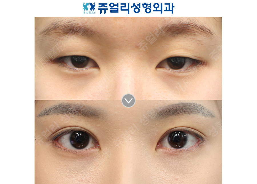 Double Eyelid Surgery