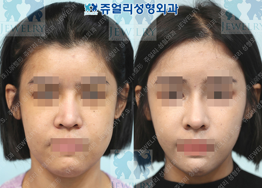 Rhinoplasty (autologous rib cartilage, revision)
