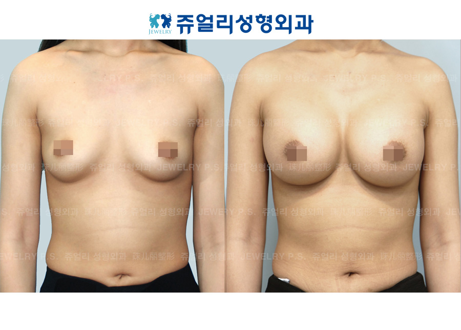 Breast Augmentation (375cc)