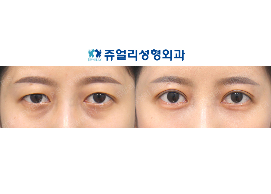 Double Eyelid (Incision), Dark Circles (Under Eye Fat Repositioning)+Loveband