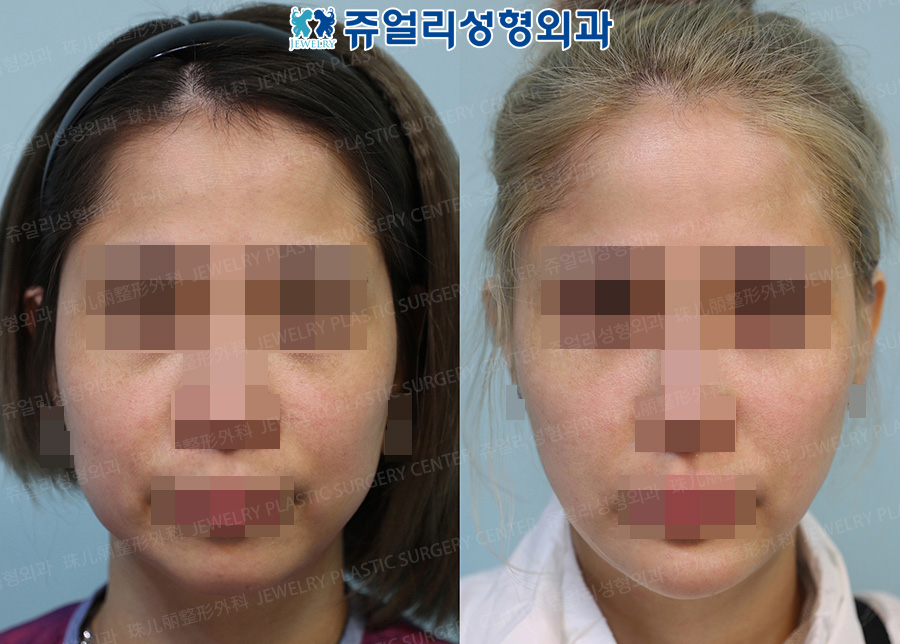 Cheek + Double Chin Liposuction, Chin Implant