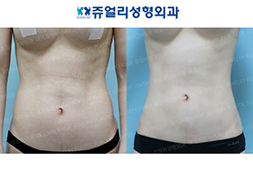 Abdominal Wall Surgery + Liposuction