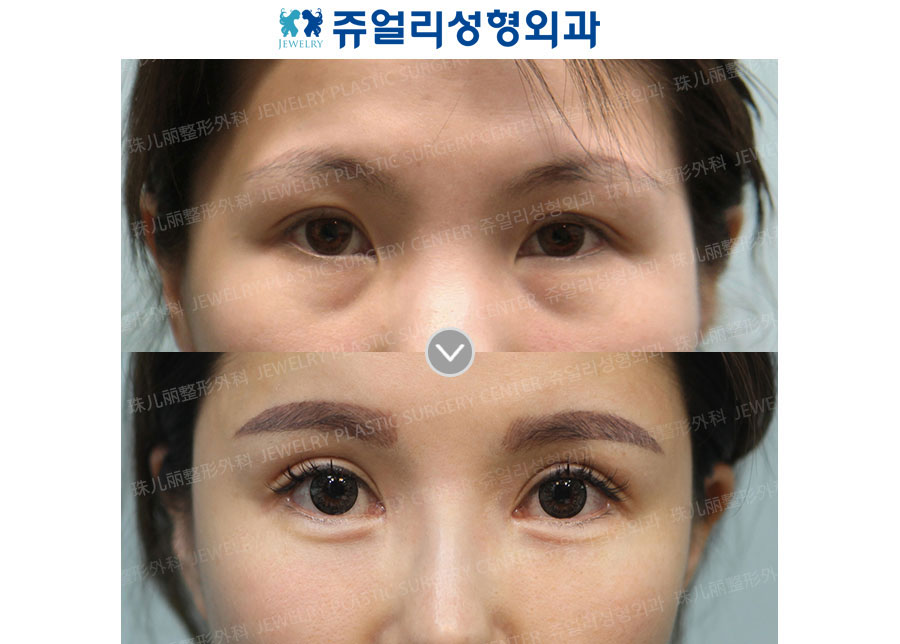Ptosis + Epicanthoplasty + Lateral Canthoplasty + Lower Lateral Canthoplasty + Fat-Repositioning Transconjunctival (Loveband)