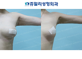 Arm Liposuction