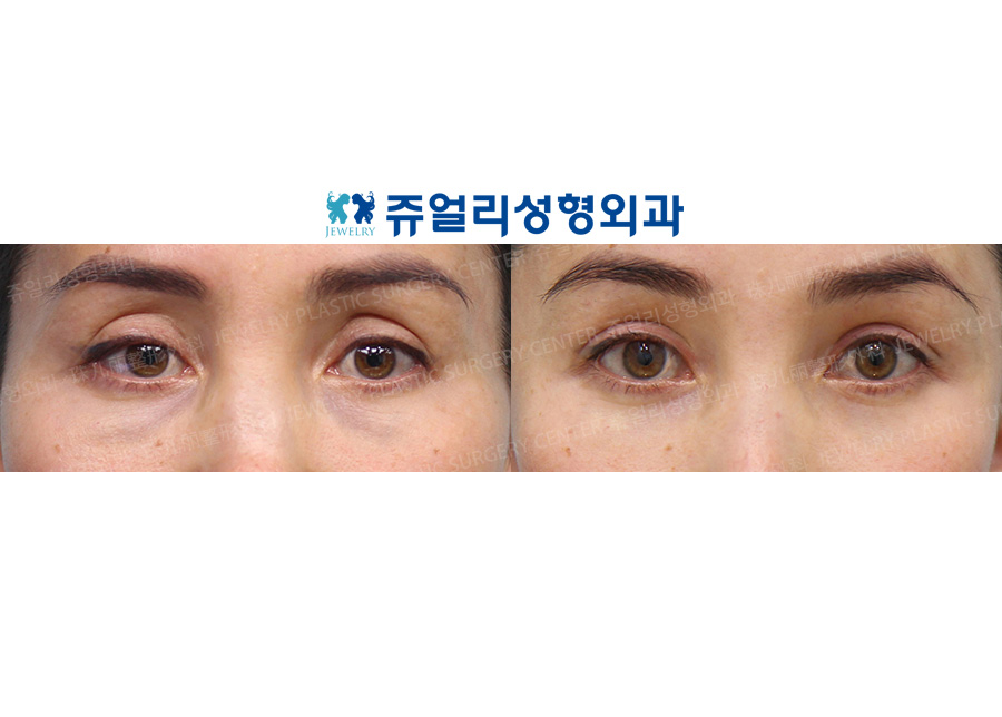 Double Eyelids Reoperation (Ptosis)+ Upper Eyelid Fat Grafting + Lower Blepharoplasty