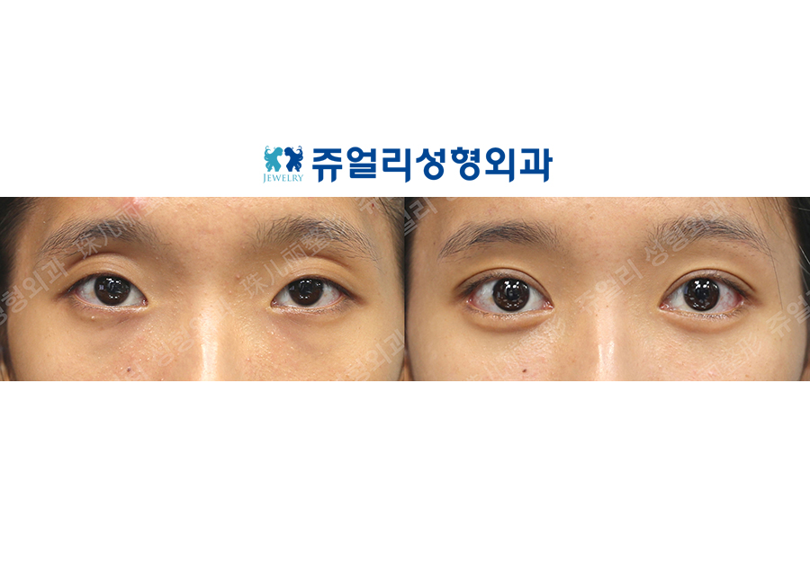 Double Eyelids (Ptosis Correction), Epicanthoplasty, Lateral Canthoplasty, Lower Lateral Canthoplasty, Under Eye Fat Repositioning (Dark Circle Eye Bag Removal, Loveband)