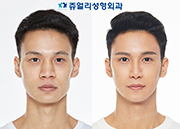 Eyes (Double Eyelids Non-Incisional, Non-Incisional Ptosis Correction+Epicanthoplasty), Nose(Osteotome, Hump Nose, Nostrils Reduction), Cheekbone Reduction, Front Chin Implant, Square Jaws Botox