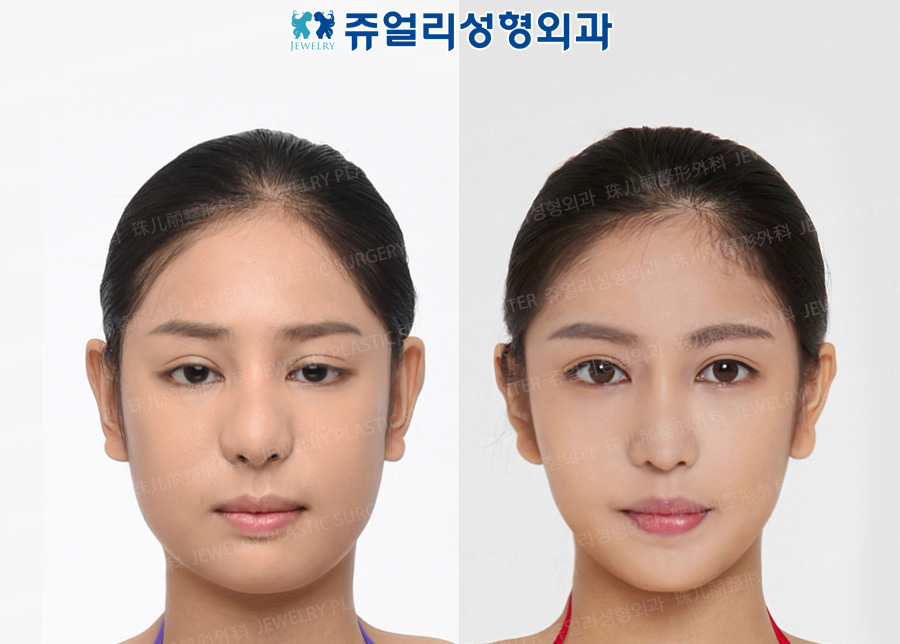 Double Eyelids Reoperation (Ptosis), Nose Reoperation, Cheek+Double Chin Liposuction, Square Jaws Reduction+T-osteotomy