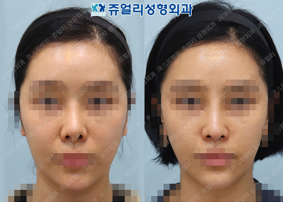 Rhinoplasty Revision (Upturned Nose Fix, Use Rib Cartilage)