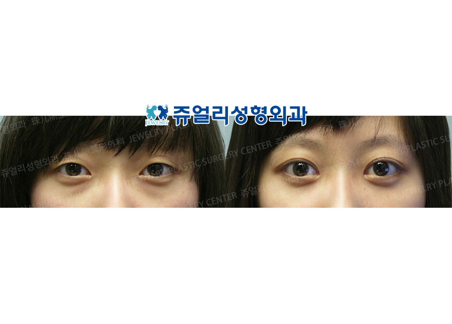 Double Eyelids + Dark Circle (Fat-Repositioning Transconjunctival)