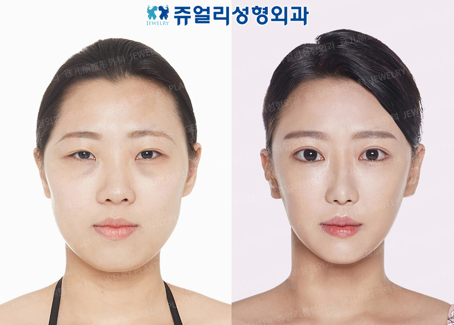 Double Eyelids (Incision), Ptosis Correction, Epi/Lateral/Lower Lateral Canthoplasty, Fat-Repositioning Transconjunctival Blepharoplasty, Nose, Fat Grafting, Facial Contouring Triple Combo (Cheekbone + Square Jaw + T-osteotomy Reduction)