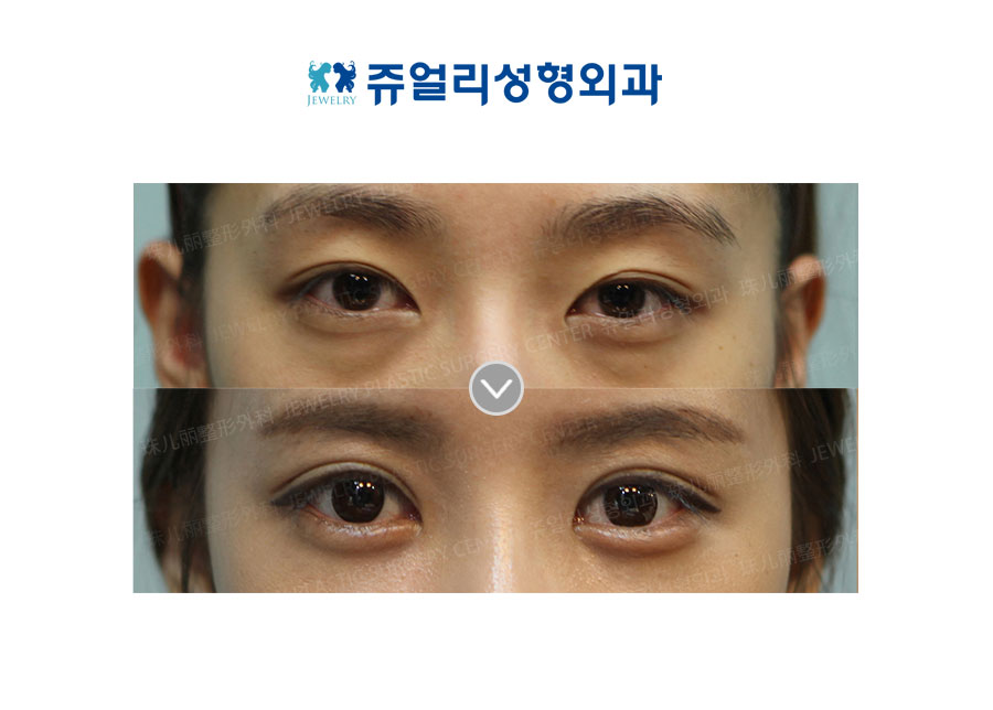 Double Eyelids Reoperation + Dark Circle Removal (Fat-Repositioning) + Loveband