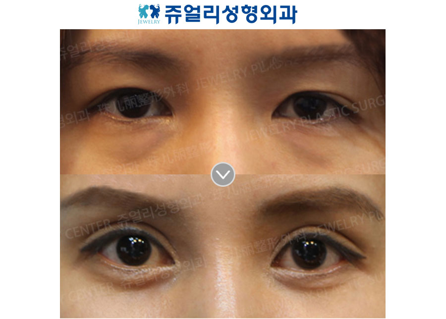 Fat-Repositioning Transconjunctival + Loveband