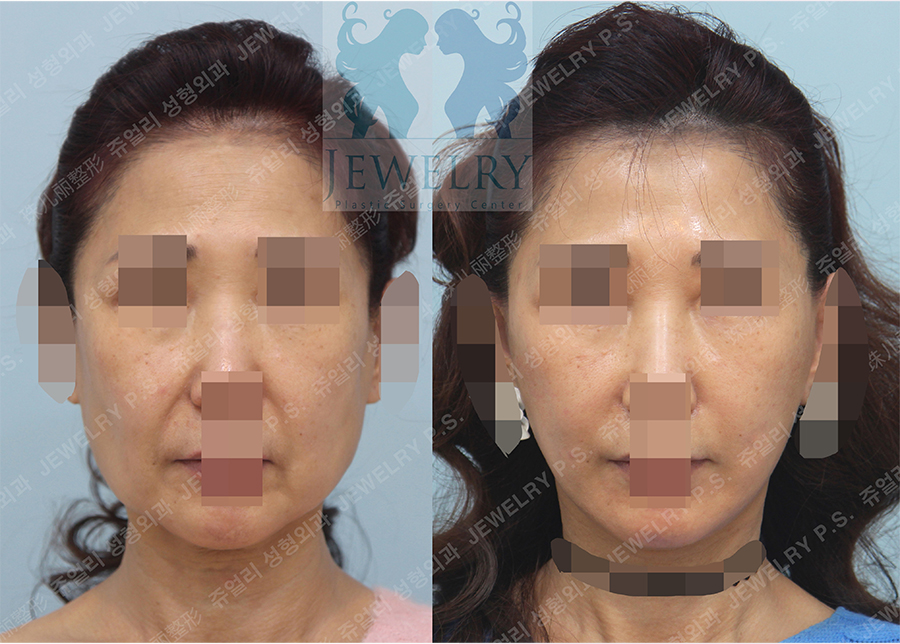 Facial Lifting, Neck Lifting