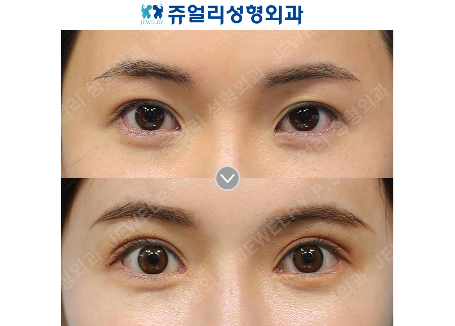 Double Eyelid Revision (Ptosis Correction) + Epicanthoplasty + Lateral Canthoplasty