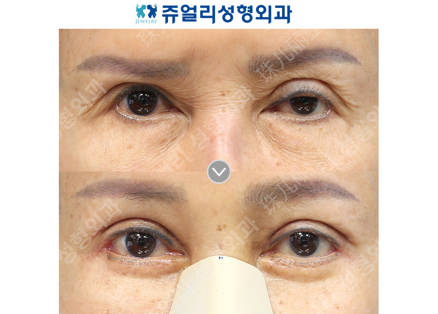 Upper blepharoplasty + lower blepharoplasty (revision)