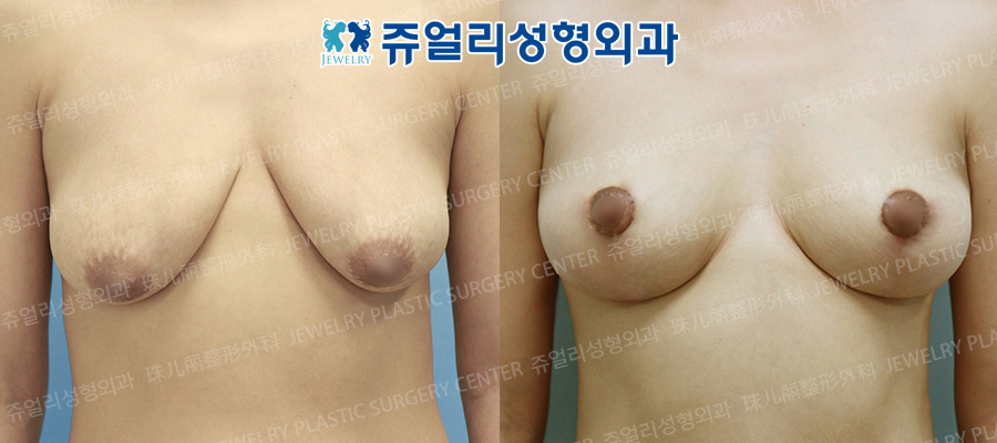 Sagging Breast Lifting + Breast Augmentation